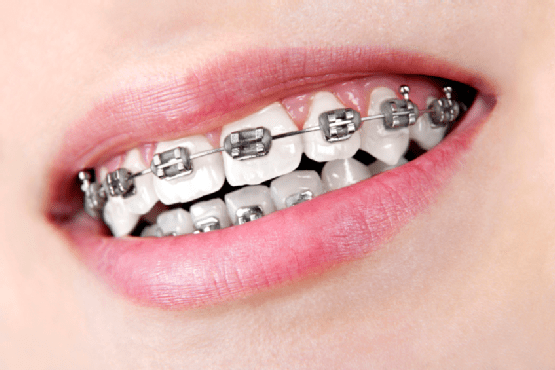 Hagyományos - ragasztott fém fogszabályozás