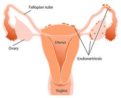 Endometriózis csomók - endometriózis tünetei, endometriózis kezelése