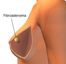 A mell jóindulatú megbetegedései: fibroadenoma