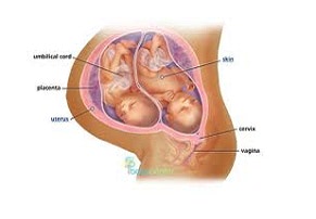 Ikerterhesség