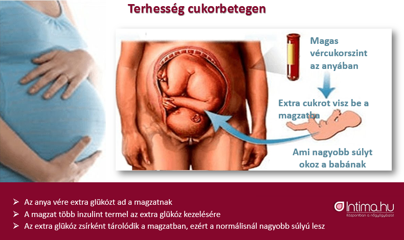 cukorbetegség kezelésére terhes nőknél)