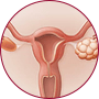 Pajzsmirigy alulműködés tünetei: rendszertelen menstruációs ciklus